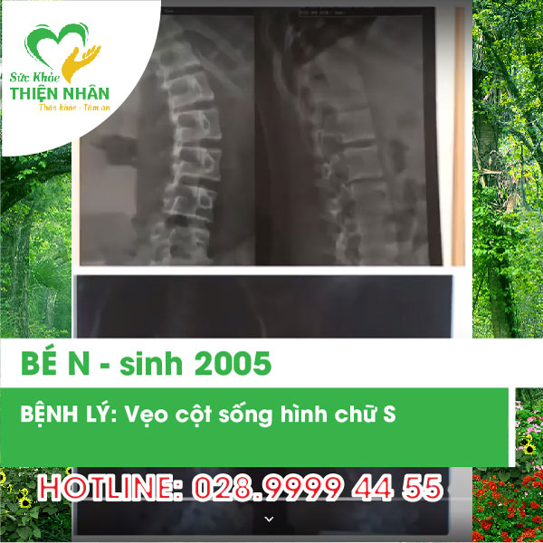 Bé N - sinh 2005 – vẹo cột sống hình chữ S