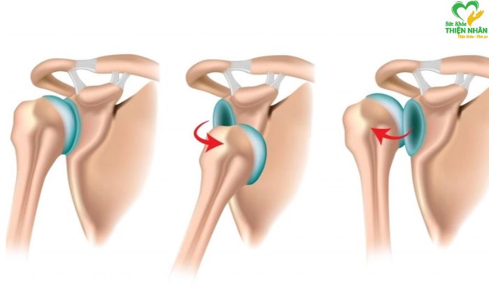 Các dạng trật khớp vai thường gặp