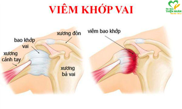 Bệnh viêm khớp vai